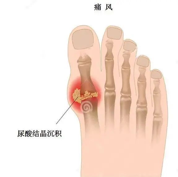痛風(fēng)為什么偏愛男性？你最關(guān)心的問題都在這里