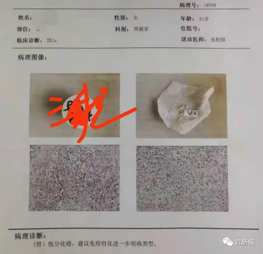 醫(yī)生總結(jié)了3位年輕胃癌患者的病例：30歲不到的他們到底干啥了？