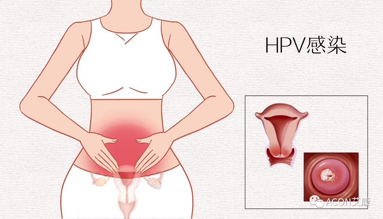 HPV轉(zhuǎn)陰其實(shí)很簡(jiǎn)單， 女性必知的宮頸癌真相