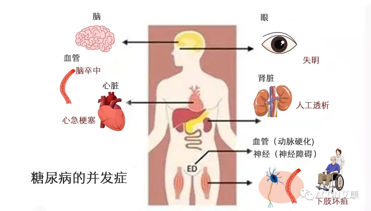 爆上熱搜，因爆發(fā)型糖尿病進(jìn)入ICU，有哪些教訓(xùn)值得我們汲取