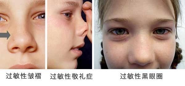 過(guò)敏性鼻炎會(huì)讓孩子變傻？！家長(zhǎng)該如何應(yīng)對(duì)